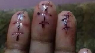 விரல்களில் அறுவை சிகிச்சை