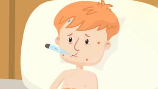A cartoon of a young boy with measles