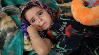 طفلة يمنية في إحدى مستشفيات صنعاء