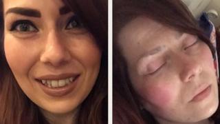 Duas fotos de Alison Morton. Em uma delas, a mulher está bem. Na seguinte, tirada poucas horas depois, está com muita dor.