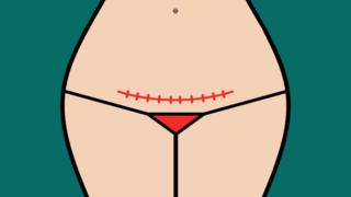 Ilustração mostra cicatriz em barriga de mulher após cesariana