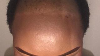 Bandile bald head