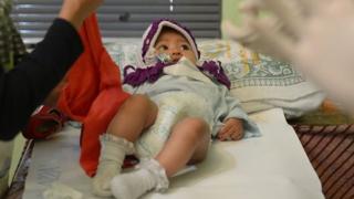 bayi, sunat, singapura