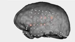 Patterns of activity on animated human brain undergoing auditory test