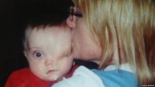 CHILD WITHOUT EYE