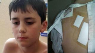 Aiden Fry - and the injuries on his back