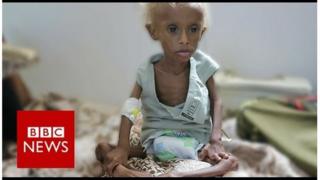 Macluusha ka jirta Yemen oo caruur badan saameysay
