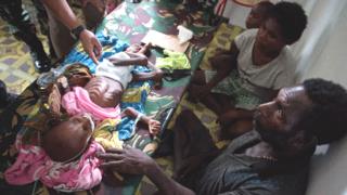 Папуасская пара сопровождает своего ребенка, страдающего от недоедания, в местной больнице в Агате