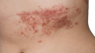 Herpes-zóster