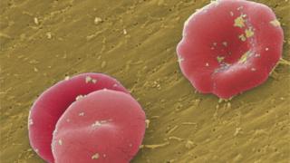 Sickle Cell Anemia