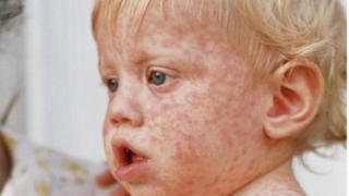 image of a boy's case with measles