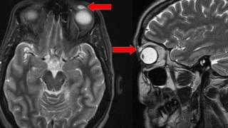 Scan of woman with contact lens lodged in her eye