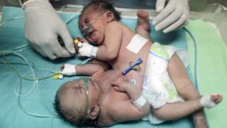Палестинские сиамские близнецы лежат в инкубаторе в детской больнице Шифа в городе Газа (2 октября 2017 года)
