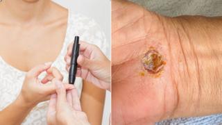 A blood glucose test and a hand with a healing wound