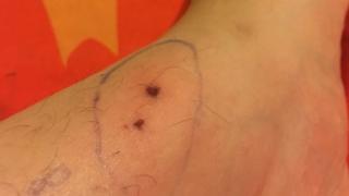 Snake bite