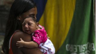 Mãe segura bebê com microcefalia