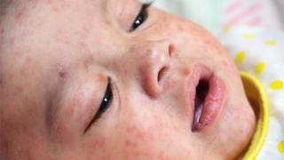 Корь. Крупный план ребенка с сыпью на лице, вызванной корью.