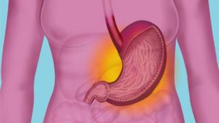Peptic ulcer fit lead to stomach cancer if dem no treat am well.