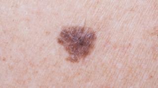A mole on the skin
