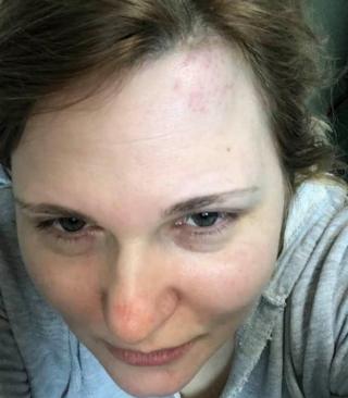 Milashina posted a picture of her bruises alongside the caption "my poor head"