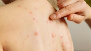 The lower part of the rash.