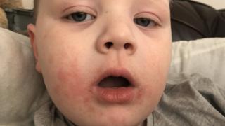 Allergic reaction hospital admissions double 11