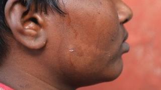 රෝගය වැළඳුනු ළමයෙක්