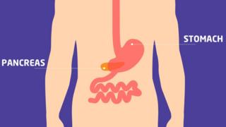 Graphic showing where the pancreas is