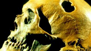 Un cráneo trepanado