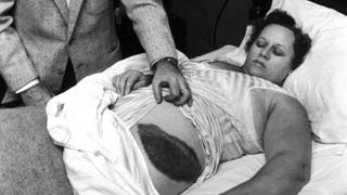 Ann Hodges y el hematoma que le causó el meteorito