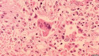 A handout image from the Centers for Disease Control and Prevention of measles viewed through a microscope in 1972