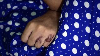 На этой фотографии, сделанной 10 октября 2014 года, на руке индийской жертвы кислотной атаки Решма видны следы ожогов, когда она отдыхает в своем доме в трущобах в восточных пригородах Мумбаи.