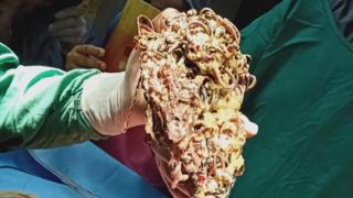 মহিলার পেট থেকে বের করা অলংকার