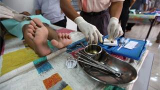 L'homme de 40 ans a vécu 17 ans sans pénis après avoir été mutile suite à des complications engendrées par une circoncision traditionnelle.