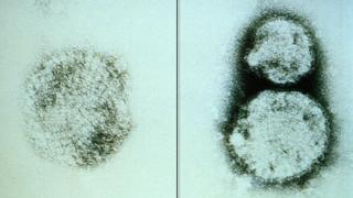 Hantavirus.