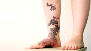Las dos piernas de Holly con las ampollas de sangre