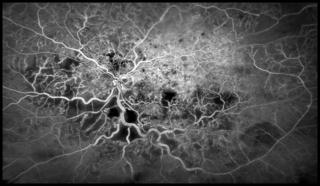 Blood vessels in the eye - Kim Baxter, Cambridge University Hospitals NHS Foundation Trust