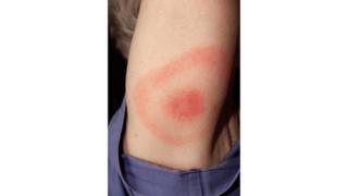 Comharra de thinneas Lyme