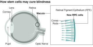 Графика: как стволовые клетки могут вылечить слепоту