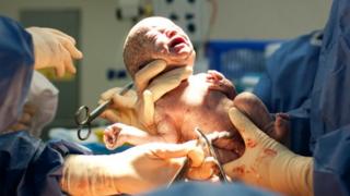 Bebé naciendo a través de una cesárea