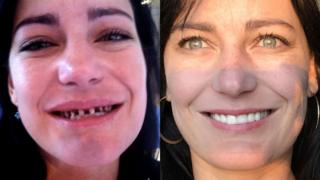 Antes e depois de Natalia