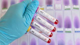 Exames de sangue para diagnóstico de ISTs