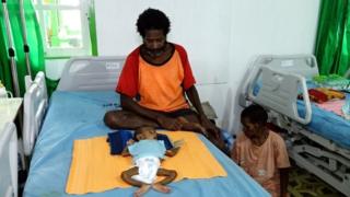 bebê com desnutrição no hospital