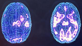 Депрессивный мозг (1) и другой после стимуляции ТМС