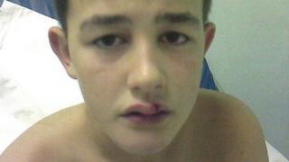 Rhys Bennett after being attacked by the police dog
