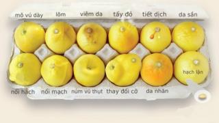 Các dấu hiệu cảnh báo ung thư vú được minh họa qua hình quả chanh
