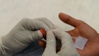 AIDS hastalığına neden olan HIV virüsü testi