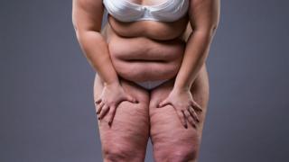 Mujer obesa