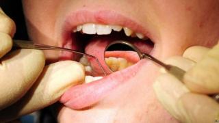 File photo: Close up of a dentist examining a patient's teeth
