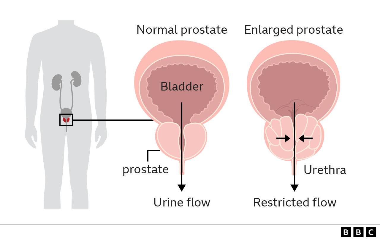 Enlarged prostate What is it and how to treat it BBC News